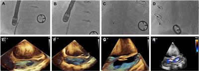 Biventricular longitudinal strain as a predictor of functional improvement after D-shant device implantation in patients with heart failure